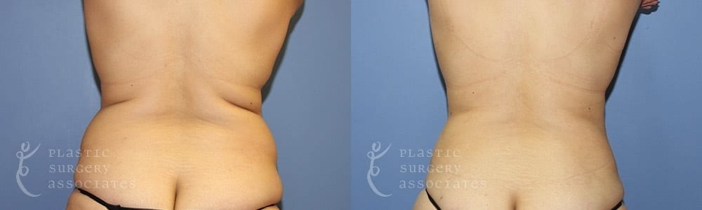 Tummy Tuck (Abdominoplasty), Woman - Age 40 - Before & After Photos
